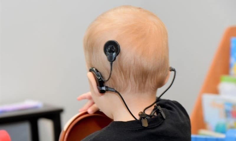 کاشت حلزون در کودکان