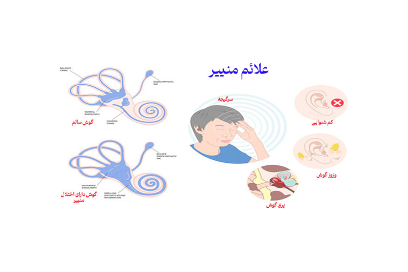 بیماری منییر